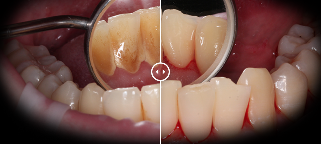 Чистка зубов (до после) - изображение 1