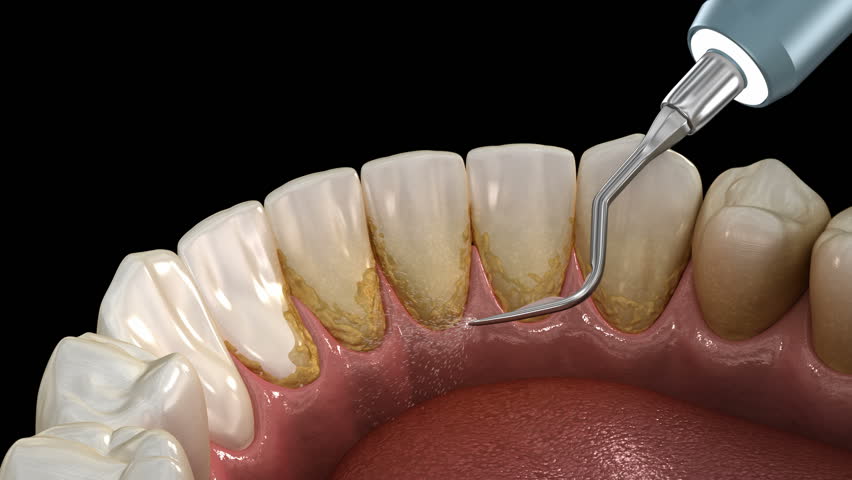 О механическом удалении зубного камня