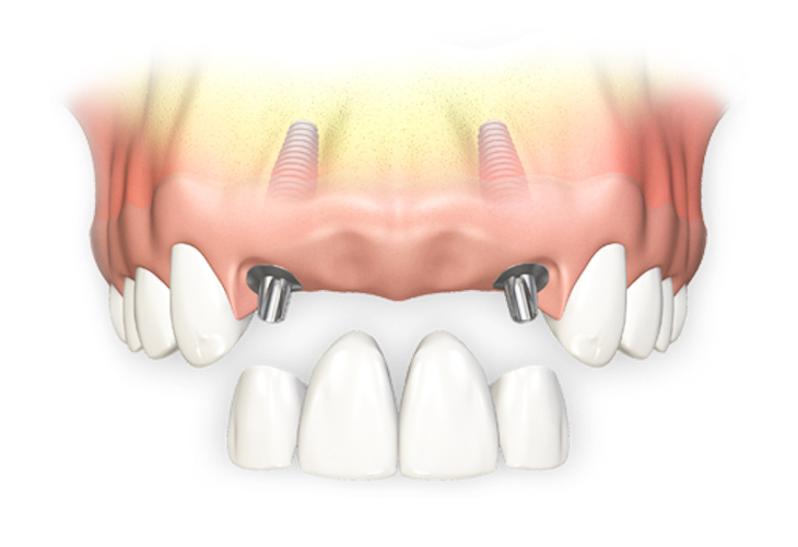 имплантация нескольких передних зубов фото