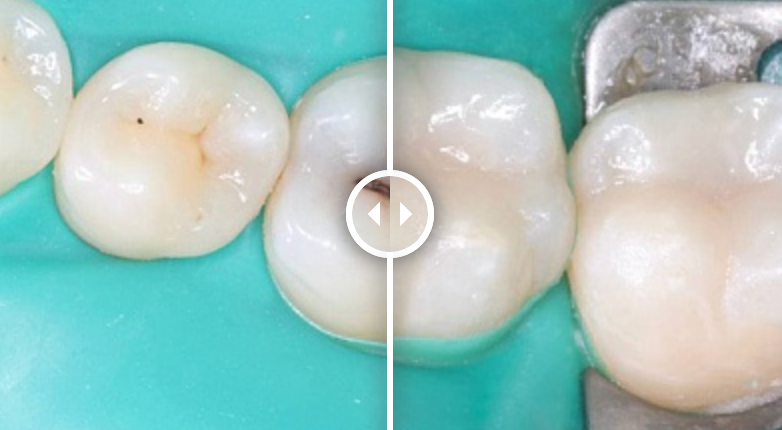 Реставрация зубов (до после) - изображение 1