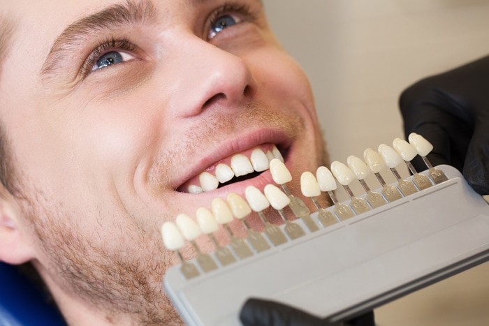 Установка композитных виниров на зубы
