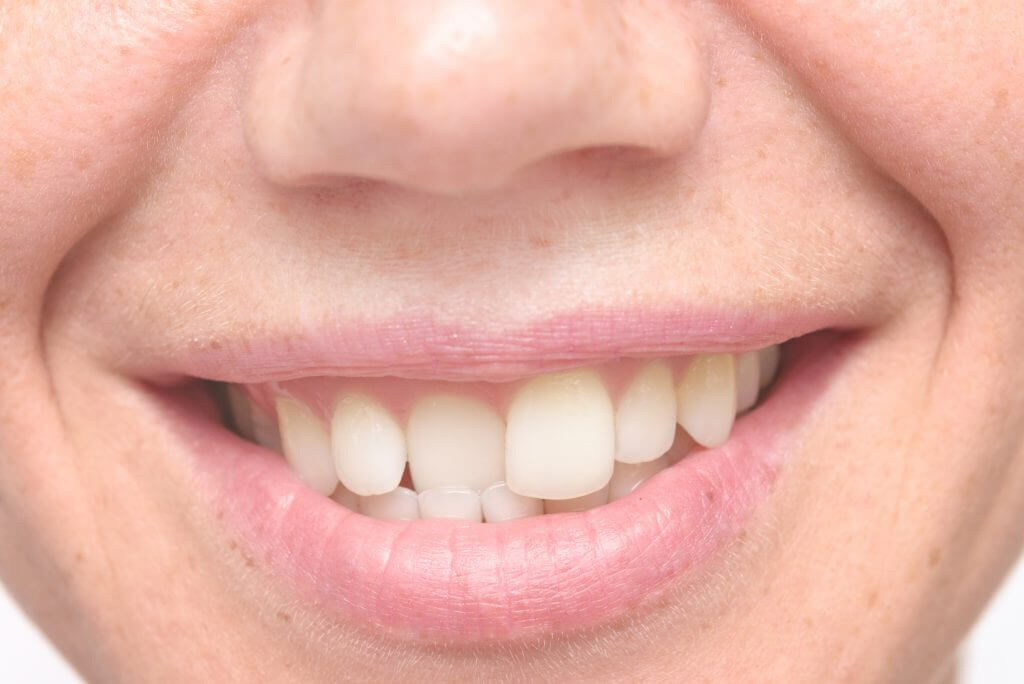 Кривые зубы