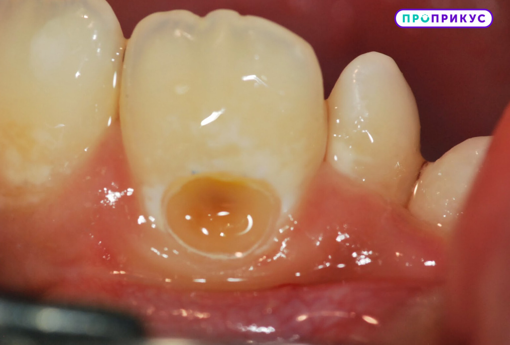 Пример пришеечного кариеса зуба