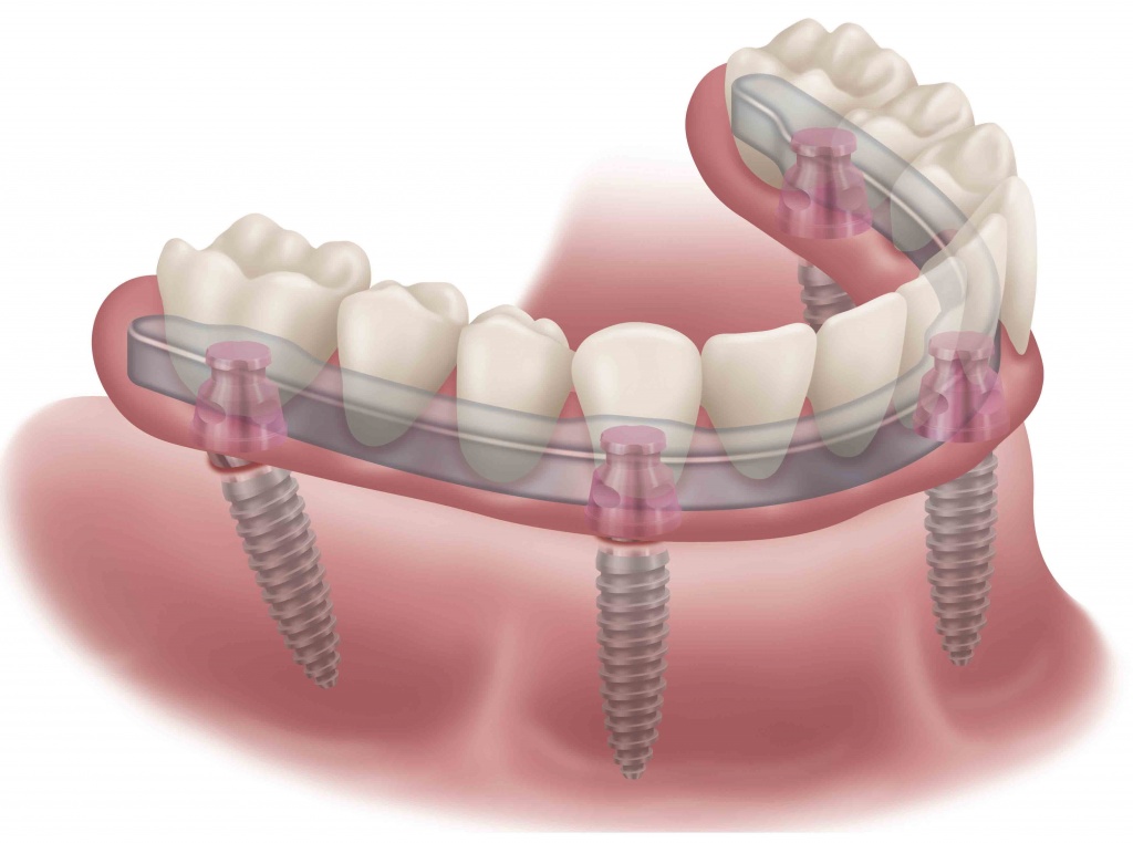 Схема несъемного протезирования зубов нового поколения