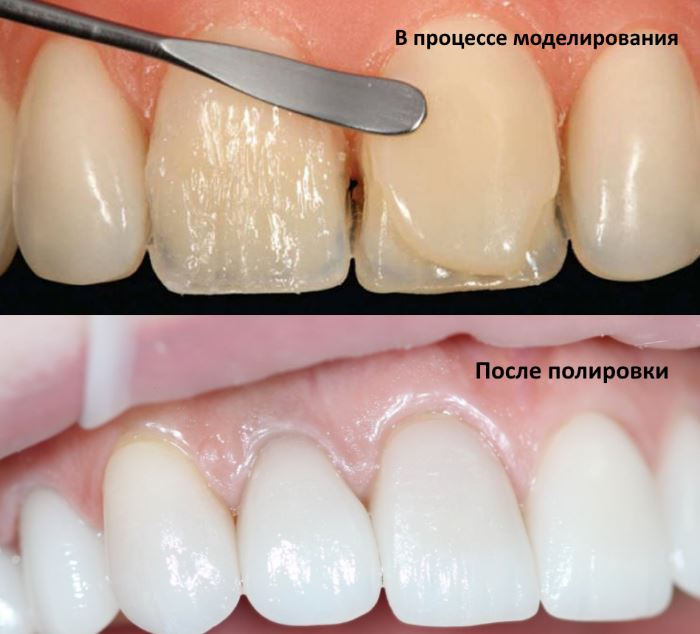 прямая реставрация переднего зуба фото