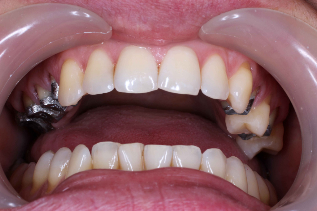 металлическая коронка на зуб фото