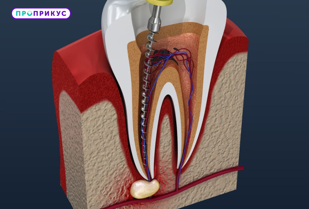 Схема лечения каналов зуба