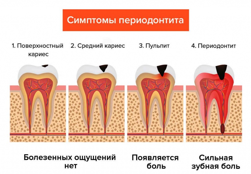 периодонтит зуба симптомы