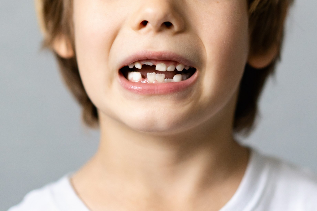 Почему зубы растут кривыми и как это исправить?