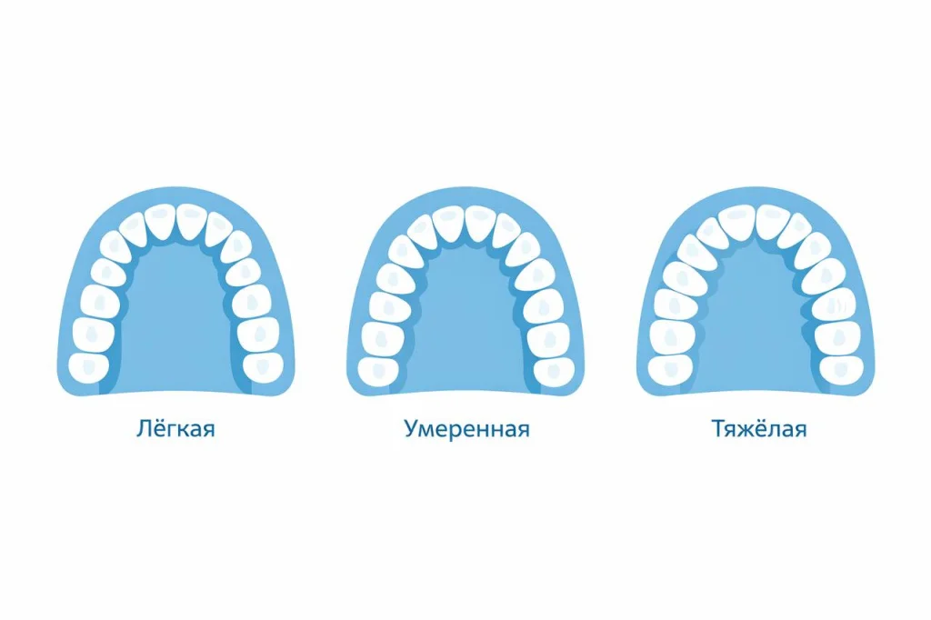 виды скученности зубов