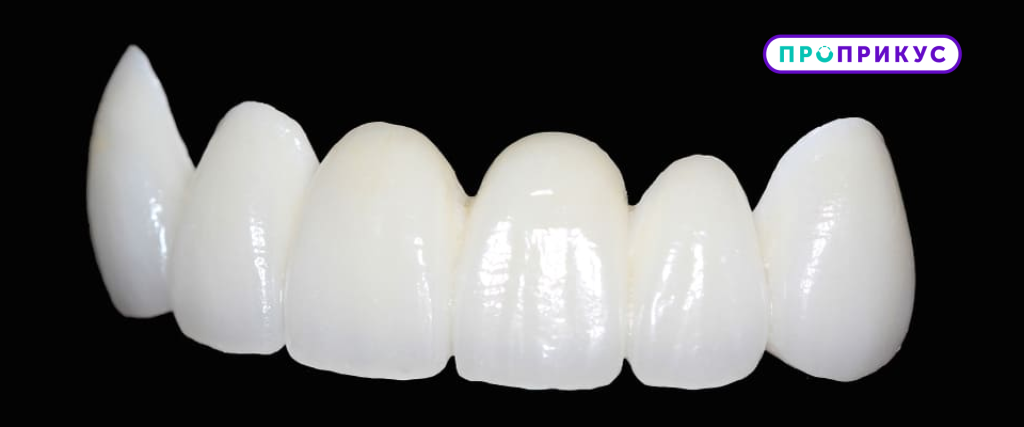 Установка мостообразных протезов на зубы