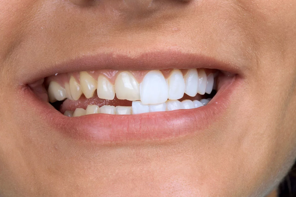 Что лучше: виниры или реставрация зубов