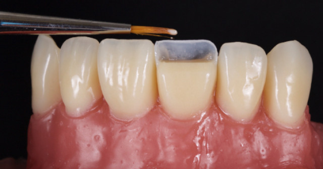 реставрация зубов композитным материалом