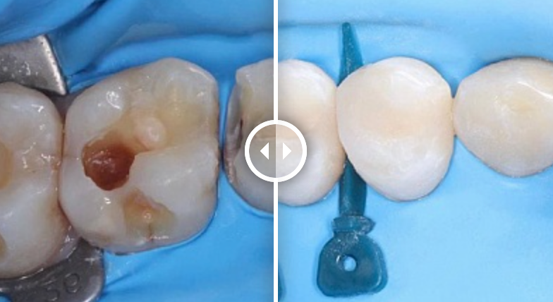 Реставрация зубов (до после) - изображение 2