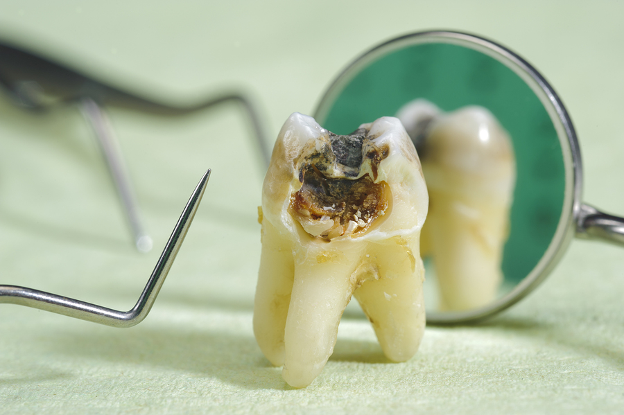 удаление корня зуба