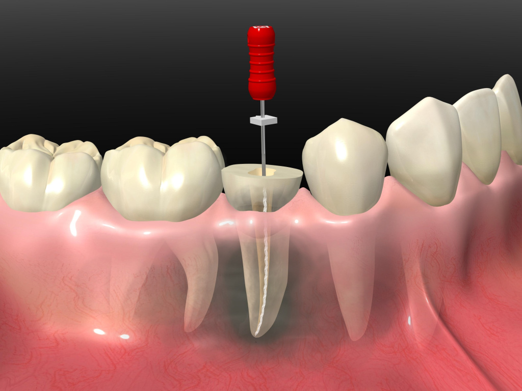 лечение перфорации зуба фото