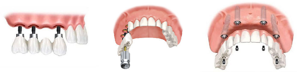 имплантация верхних жевательных зубов фото