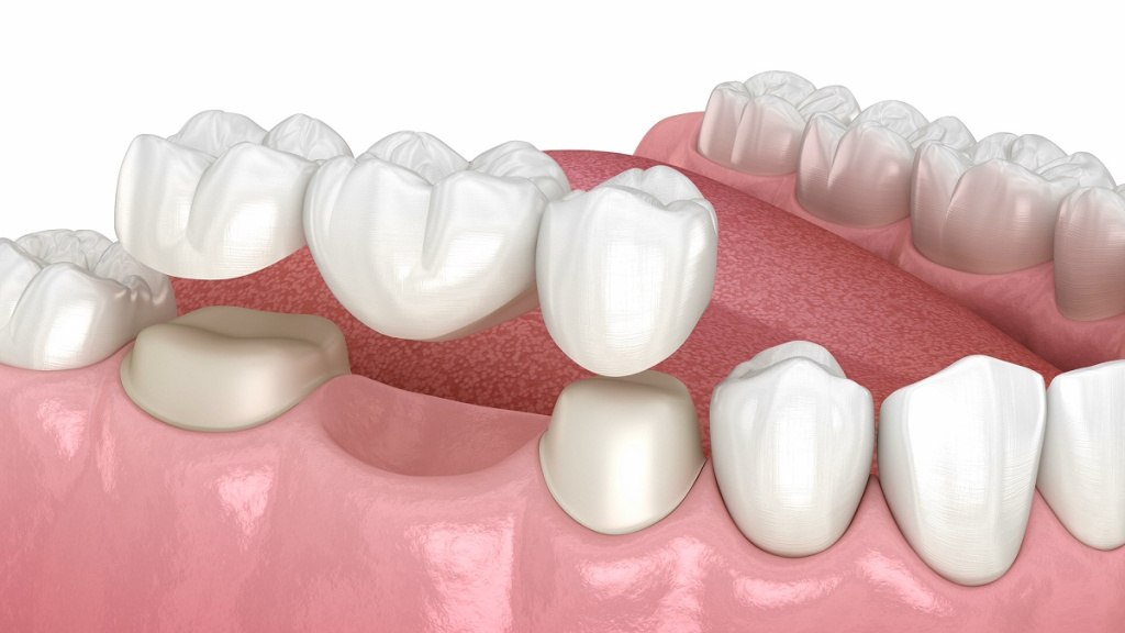 Что такое зубной мост?