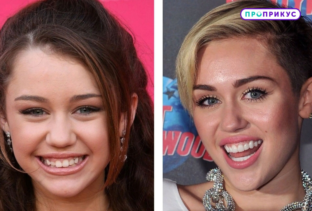 голливудская улыбка до и после (актеры) - изображение 3