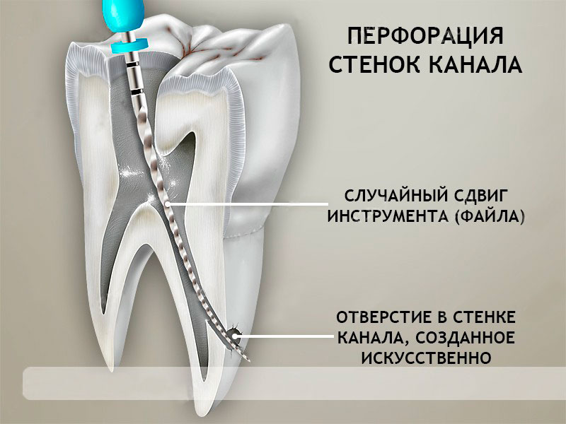 перфорация зуба фото