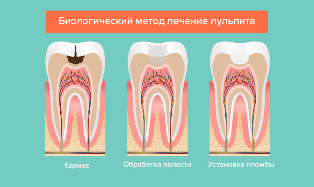 Что такое пульпит зуба: симптомы, формы, лечение пульпита