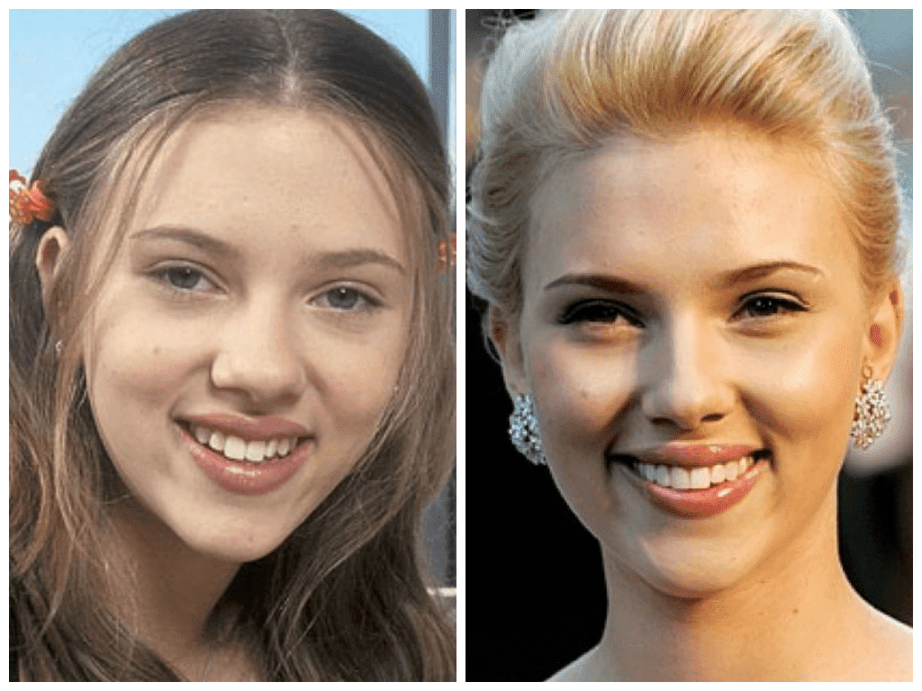 голливудская улыбка до и после (актеры) - изображение 1