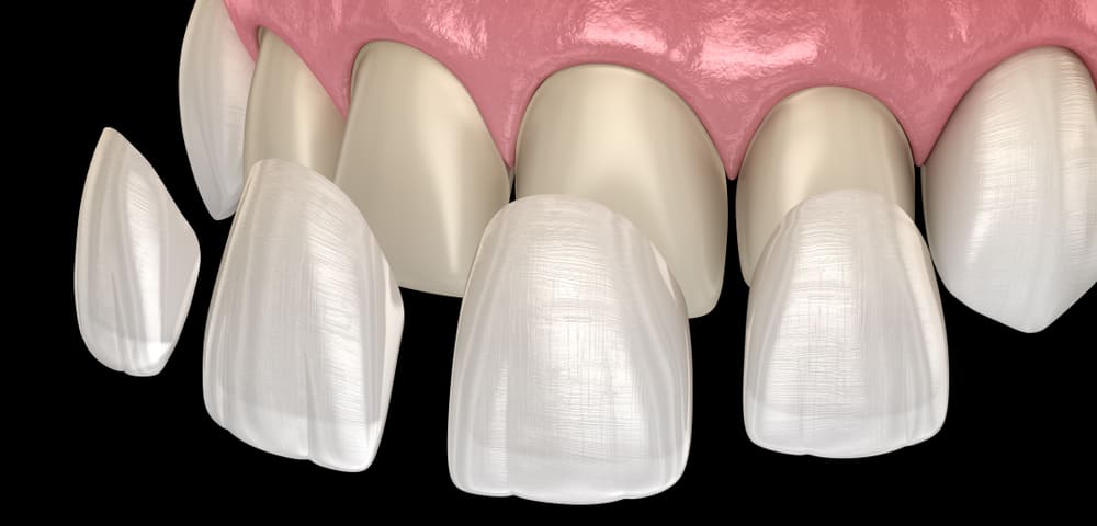 : Схема наложения керамических виниров на зубы
