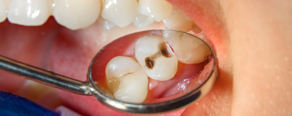 диагностика зубного кариеса