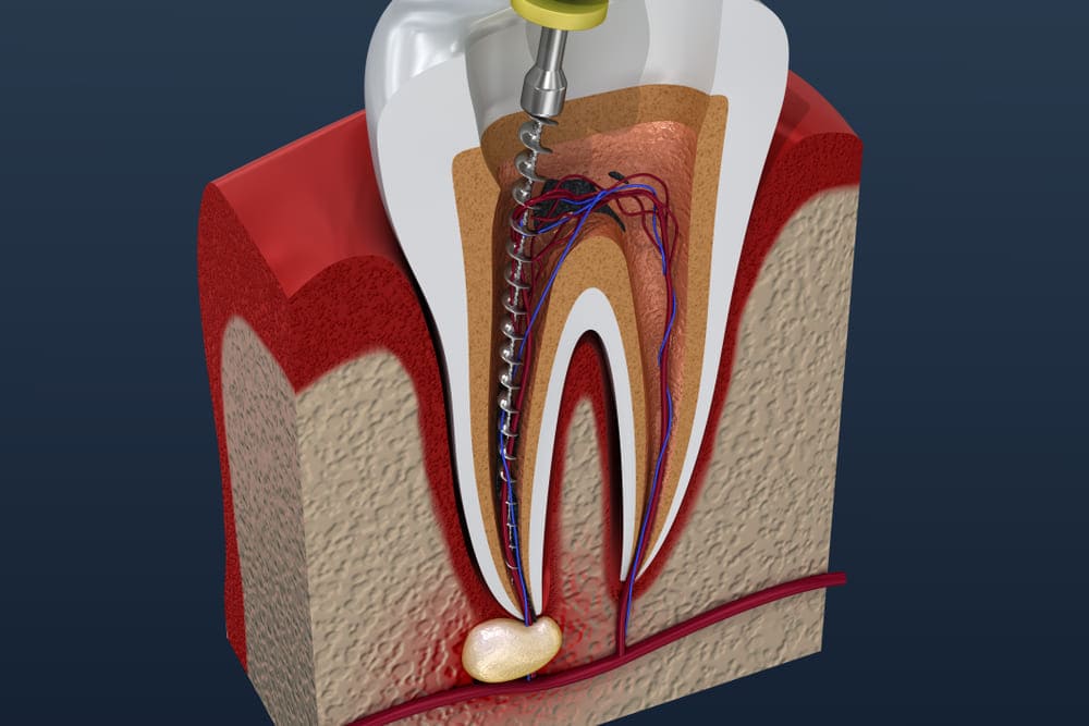 Схема лечения каналов зуба