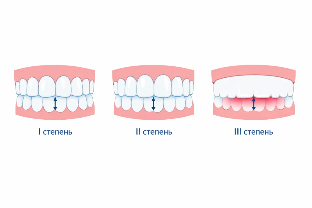 степени глубокого прикуса — сравнение перекрытия