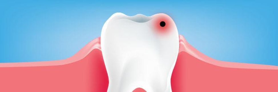 Очаг кариеса на зубе