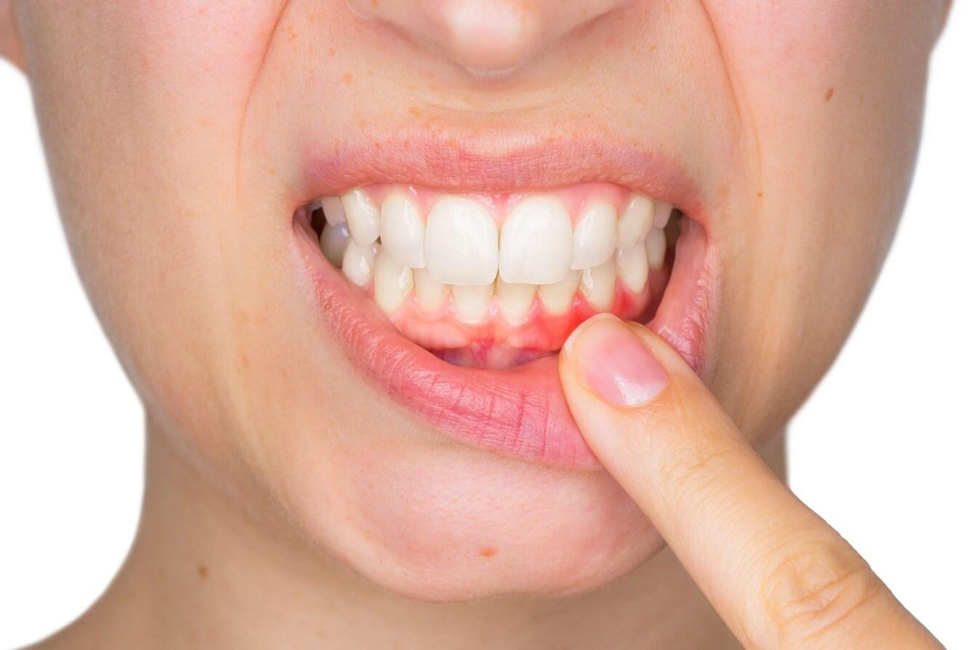 Пример периодонтита зуба