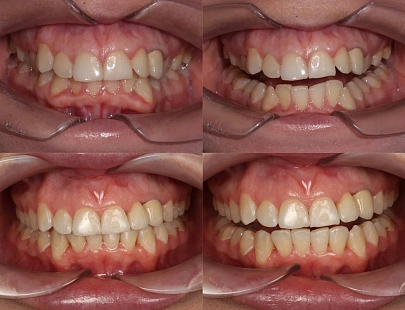 Скученность зубов на обеих челюстях — лечение на элайнерах Star Smile