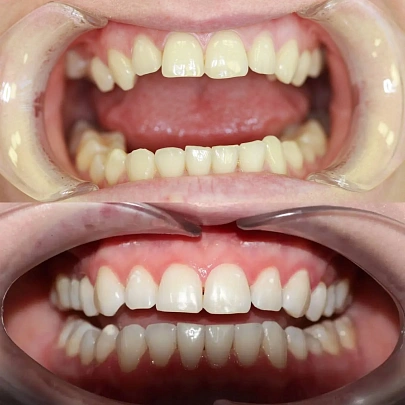 Неровные зубы и нарушение прикуса — лечение на элайнерах Star Smile