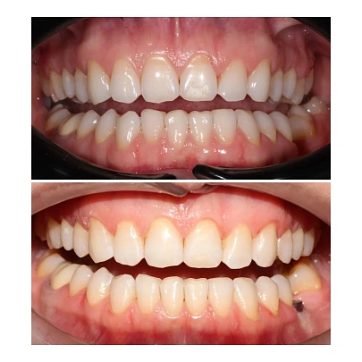 Стираемость зубов, отсутствующий зуб и неправильный прикус — лечение на элайнерах Spark + имплантация