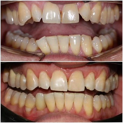 Неровные зубы и нарушение прикуса — лечение на элайнерах Star Smile