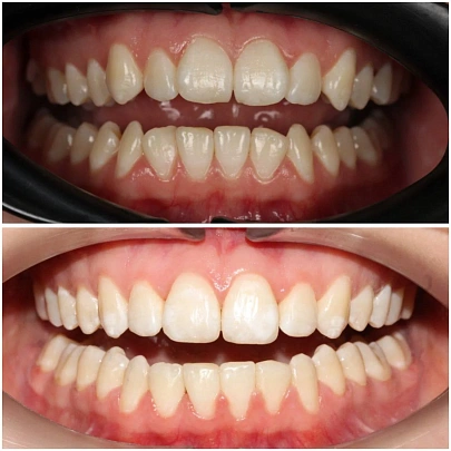 Неправильный прикус и неровные зубы — лечение на брекетах за 16 месяцев