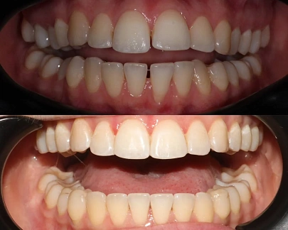 Неправильный прикус и положение зубов — лечение на элайнерах Spark