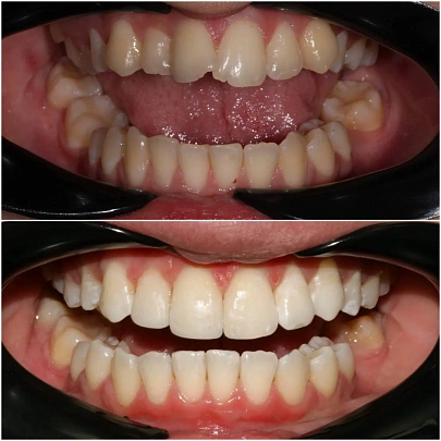 Неровные зубы и неправильное смыкание — лечение на элайнерах 3D Smile