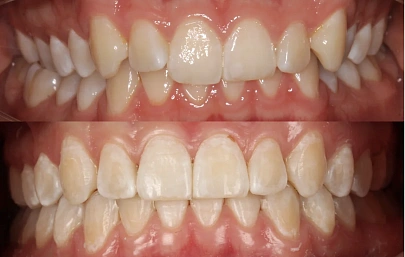 Неправильное положение зубов и нарушение прикуса — лечение на элайнерах Invisalign