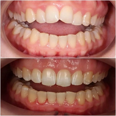 Сужение челюстей и боль в суставе — лечение на брекетах H4