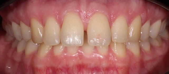 Неправильный прикус и положение зубов — лечение на элайнерах 3D Smile