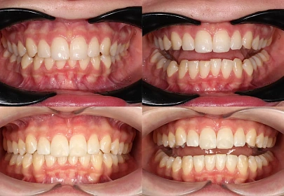 Скученность зубов и сужение челюстей — лечение на элайнерах Click