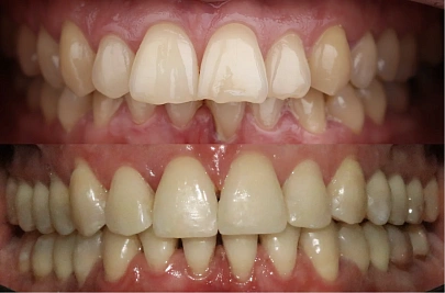 Скученность зубов и сужение челюстей — лечение на элайнерах Spark