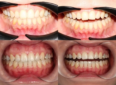 Асимметрия лица, щелчки в суставе и стираемость зубов — лечение на элайнерах Click