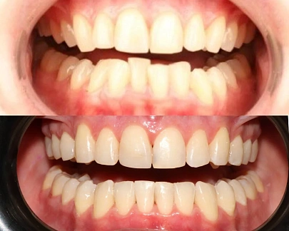 Неправильный прикус и положение зубов — лечение на элайнерах Spark