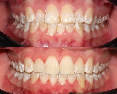 Лечение неправильного прикуса зубов на элайнерах Click Aligners за 23 месяца