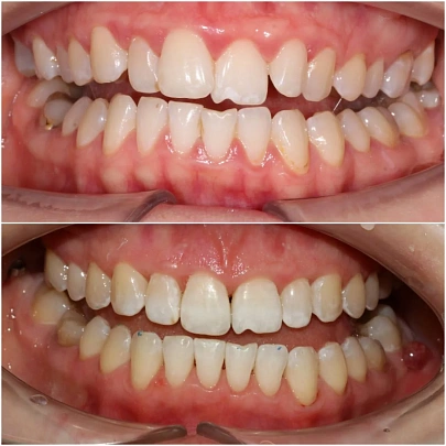 Неровные зубы и неправильное смыкание — лечение на элайнерах 3D Smile