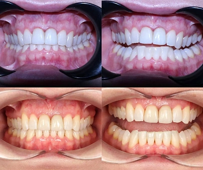 Скученность, глубокий прикус и старые коронки — лечение на элайнерах Click