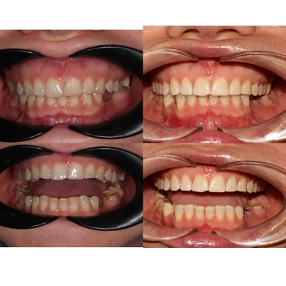 Неровные зубы и нарушение прикуса — лечение на брекетах H4